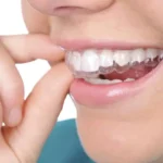 Ways to Straighten Your Teeth Without Braces