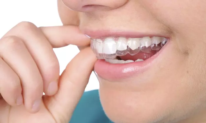 Cosmetic-Teeth-Straightening