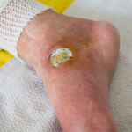 Be Aware of What a Diabetic Foot Ulcer is