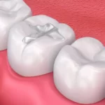5 Benefits of Dental Resin Fillings