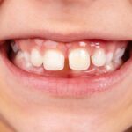 The Best Treatment Options for Closing Teeth Gaps