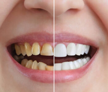 Treatment and whitening of teeth, dental crowns. Before and after. Dentistry. Close-up.