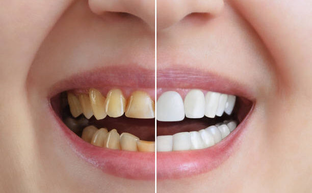 Treatment and whitening of teeth, dental crowns. Before and after. Dentistry. Close-up.