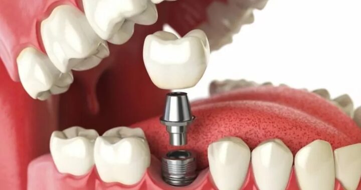 Exploring the Benefits of Dental Implants for Missing Teeth