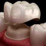 Dental Crowns –Restoring Strength, Function, And Aesthetics.
