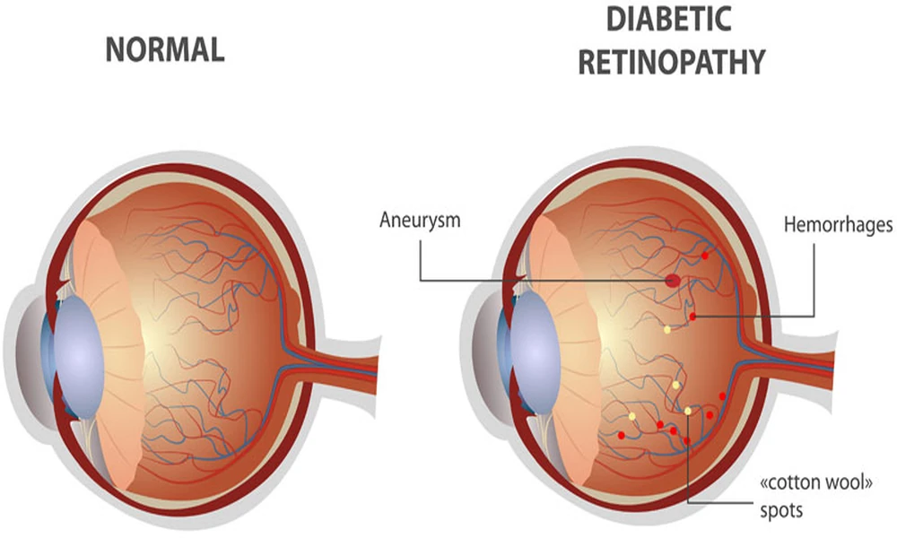 Can Diabetic Retinopathy Cause Permanent Blindness?